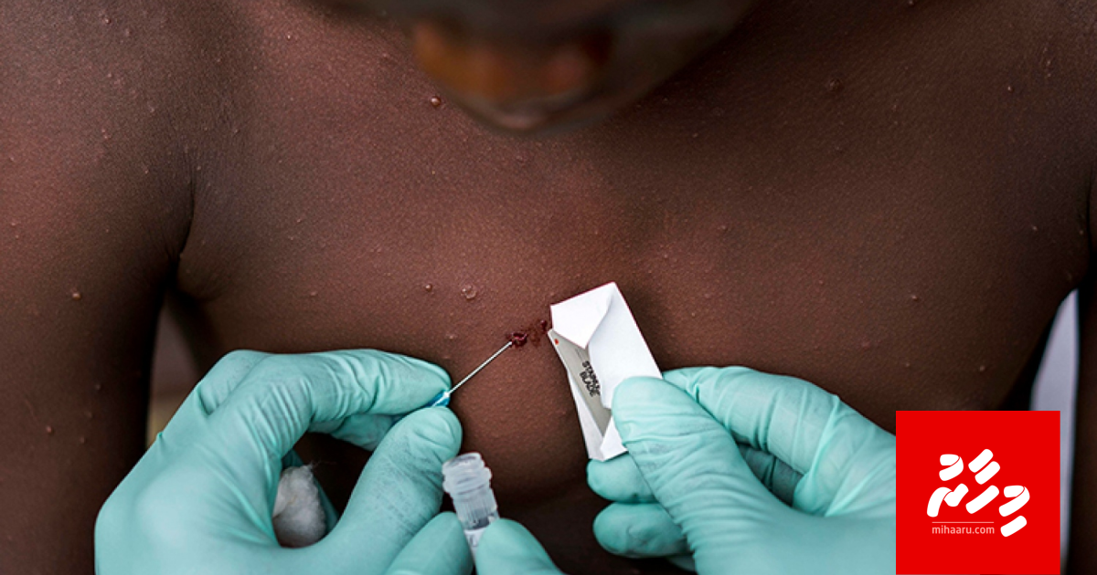 Mpox ge nurakkaa mulhi dhuniyeah eba oiy kamah kanda alhaifi