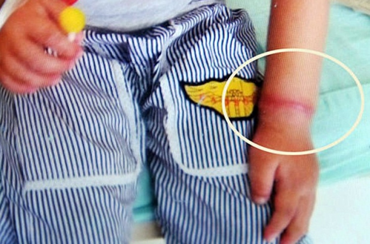 ރަބަރުފަށަކާ ހެދި ކުއްޖެއްގެ އަތް ބުރިކޮށްލާ ހިސާބަށް