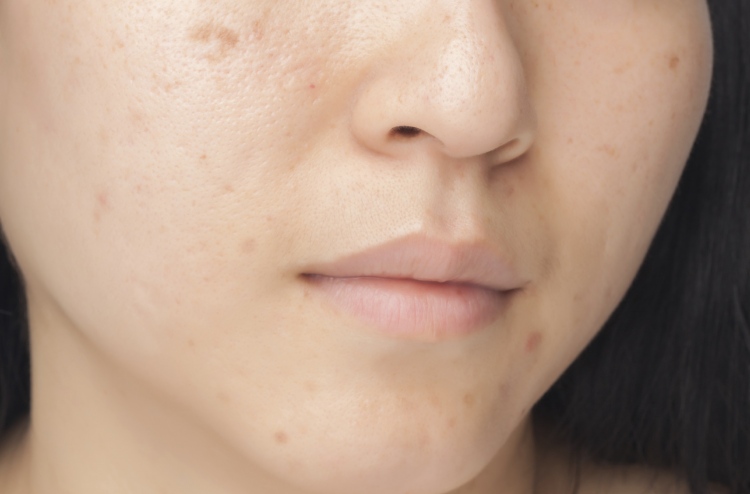 ފުރާވަރުގައި މޫނުގައި ބިހި ނެގުމުން މުސްކުޅިވުން ލަސްވޭ