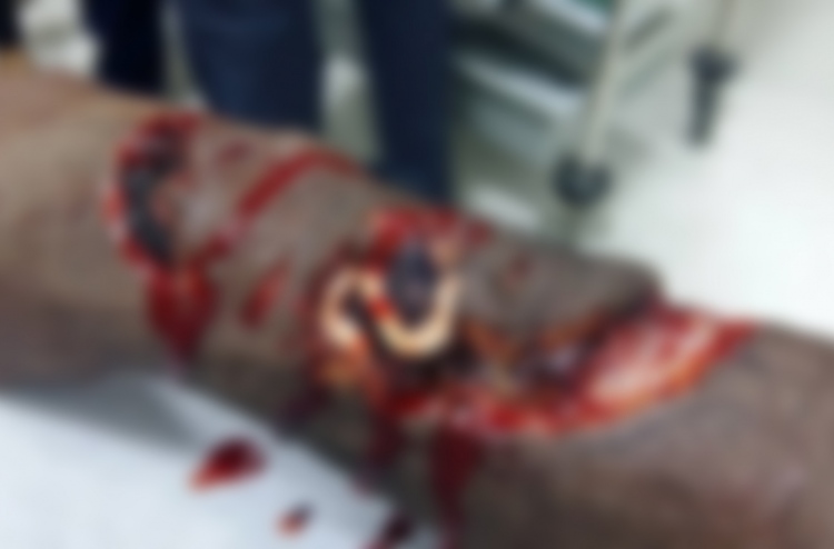 މިޔަރެއް ދިން ހަމަލާގައި ޒަހަމްވި މީހާ ލަންކާ އަށް