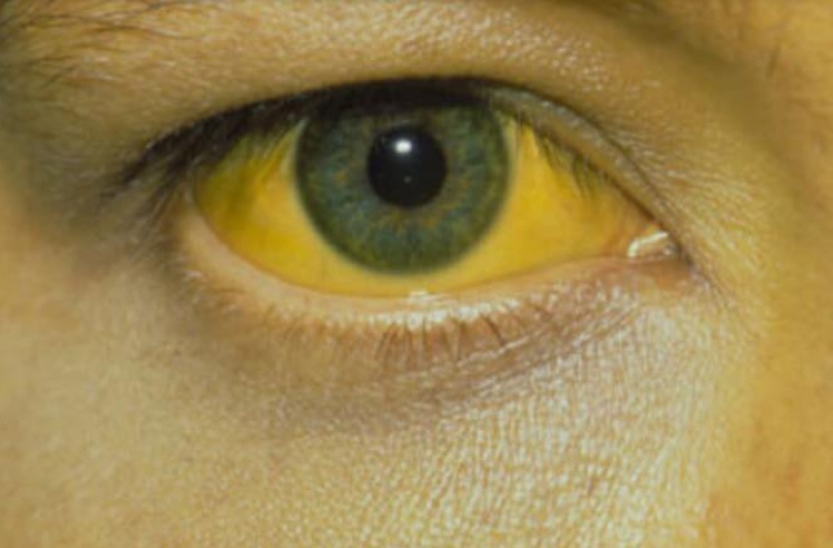 ފަރުވާ: ހެޕަޓައިޓިސް އަކީ ކޮބާ؟