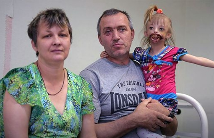 މޫނުގެ އެއްފަޅި ނެތުމުން ކުއްޖަކު ބާކީވެފައި