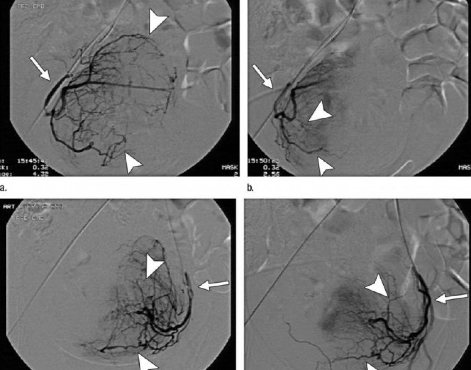 ޕާޝިއަލް ޔޫއެފްއީ އެއްގެ ޑިޖިޓަލް ސަބްޓްރެކްޝަން އެންޖިއޮގްރަފީ އިމޭޖެއް