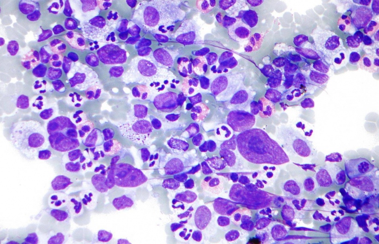 ރޯގާގެ ވައިރަހަކުން ބްލެޑާ ކެންސަރު ސެލް މަރުވޭ