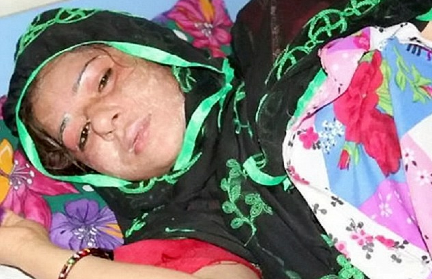 ފަރާ އަށް ހޮސްޕިޓަލްގައި ފަރުވާ ދެނީ: ފިރިމީހާ އެސިޑް ޖެހީ އަންހެން ކުއްޖަކު ވިހެއުމުން.