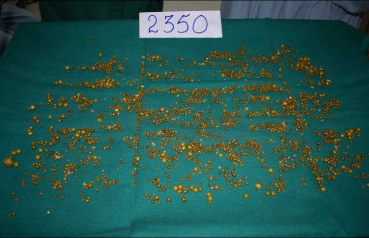 އަންހެނެއްގެ ގޮހޮރުން 2،000 ގިނަ ހިލަކޮޅު ނަގައިފި