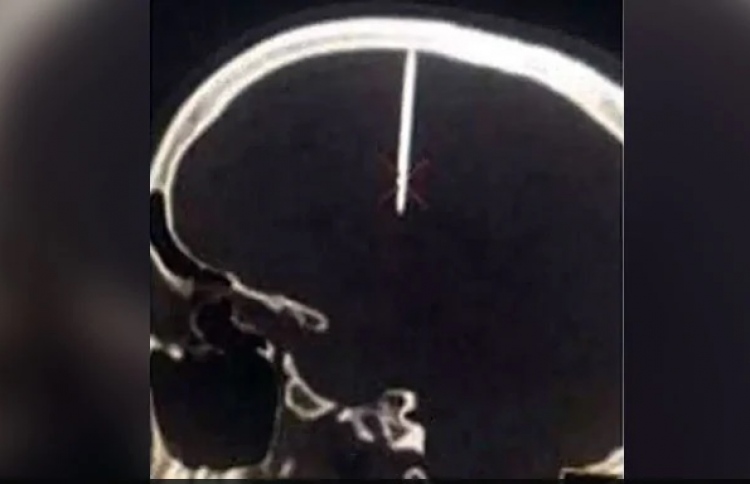 ބޮލުގައި މޮހޮރެއް؛  ވަނީ ކިހިނެއް ކަމެއް ނޭނގޭ