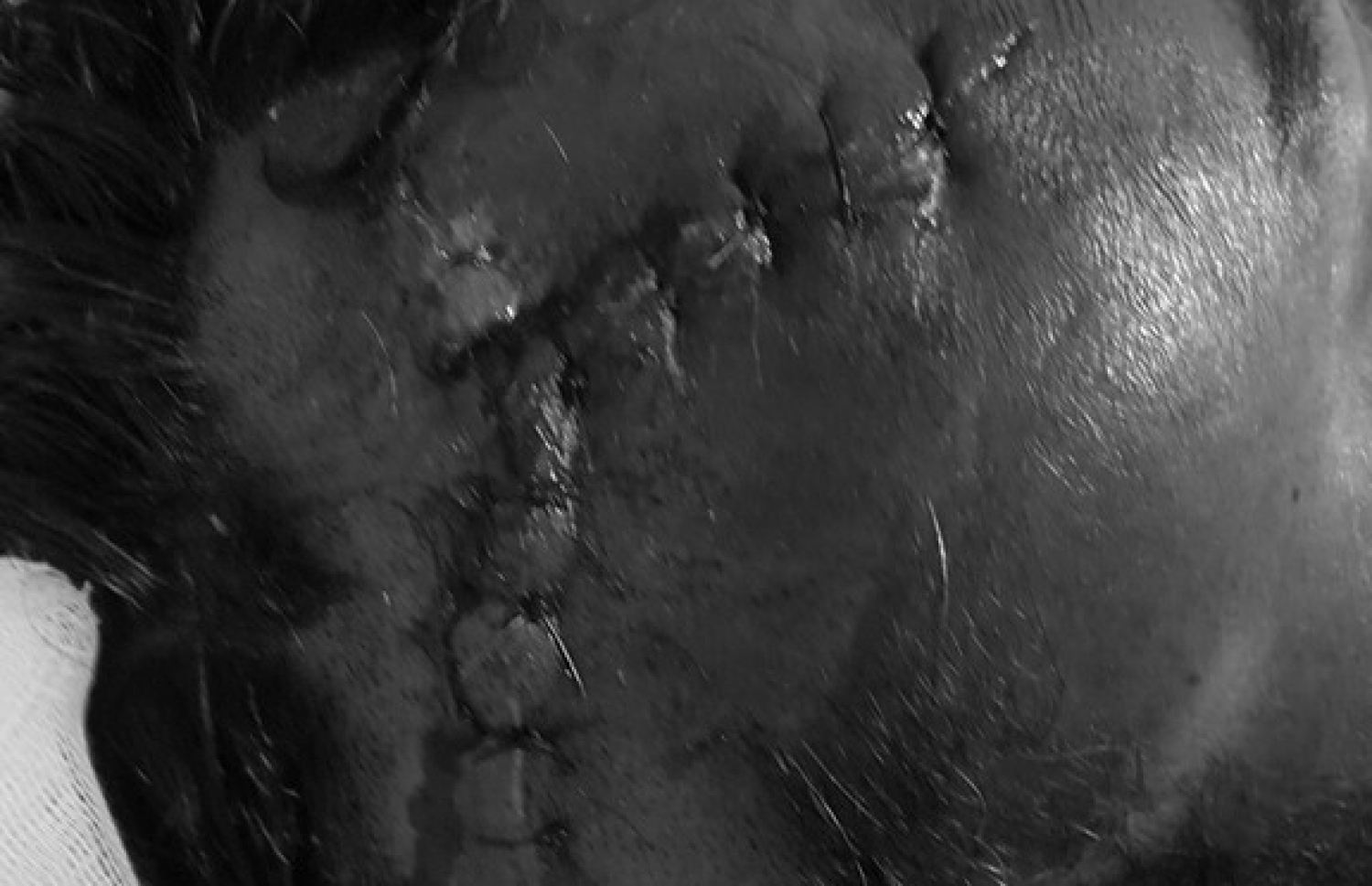 ސިނަމާލެ ބްރިޖުގައި އެކްސިޑެންޓުވި އަހުމަދު ފަޒާލް ބޮލުގެ އޮޕަރޭޝަނަށް ފަހު: އެކްސިޑެންޓުވީ ފަހަތުން ދުއްވާފައި ދިޔަ ސައިކަލެއް ޖެހިގެން -- މިހާރު ފޮޓޯ