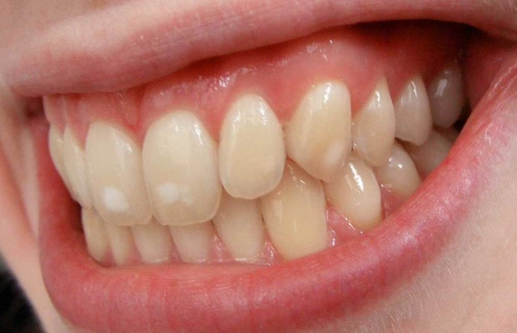 ދަތް އުނގުޅާ ބޭސް މާގިނައިން ބޭނުންކުރާތީ ގެއްލުންވޭ