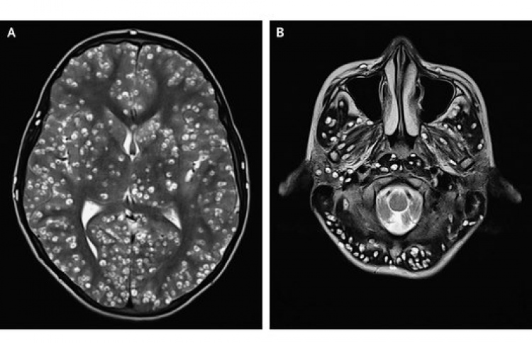 މީހެއްގެ ސިކުނޑިތެރޭ ފަންޏެއް ބިސް އެޅުމުން މަރުވެއްޖެ