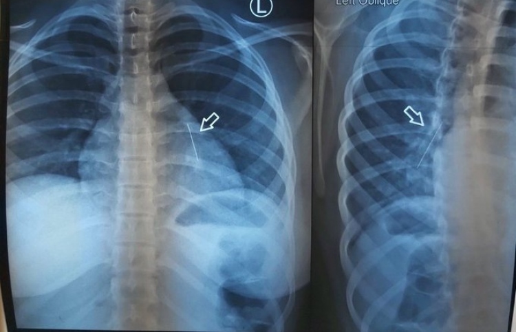 ކުޑަކުއްޖާގެ މޭގަ ތާށިވި އެތިކޮޅު އިންޑިއާއިން ނަގައިފި