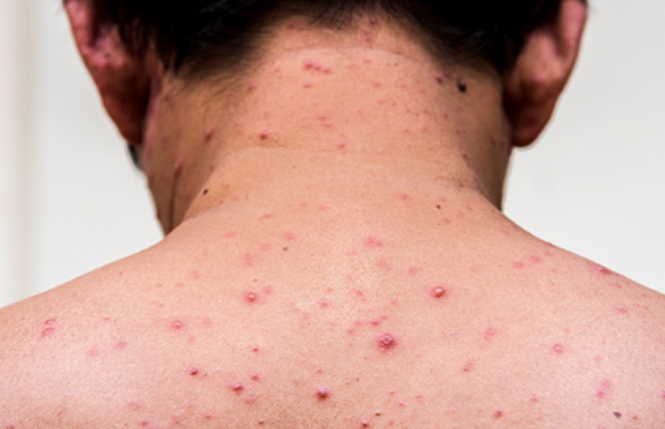 ހިމަބިހި ޖެހިފައިވާ މީހަކު އަނެއްކާ ވެސް ފެނިއްޖެ