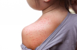 Red rashes on a child infected with measles. 