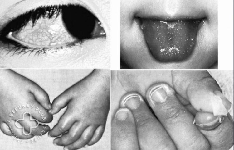 މިސްކް ޖެހުމުން ފެންނަ އަލާމާތްތައް މިހާރު ތަފާތު