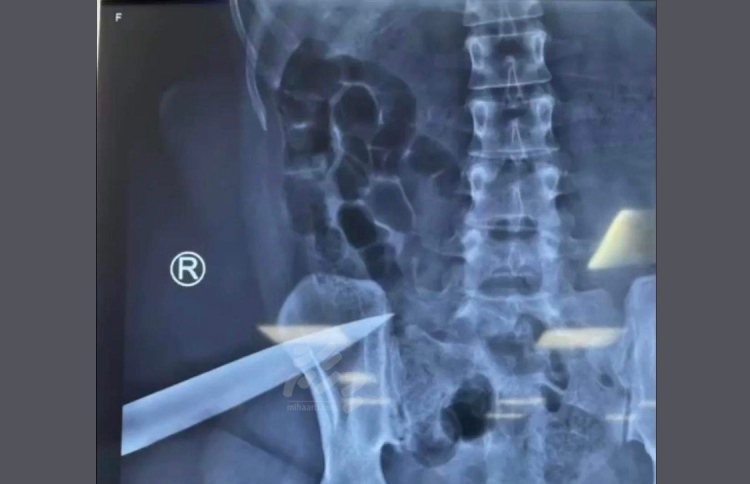 އަނބިމީހާގެ ގަޔަށް ވަޅިހެރީ ނިދާފައި އޮއްވައި