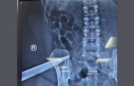 ޒަހަމްވި އަންހެން މީހާގެ އެކްސްރޭ