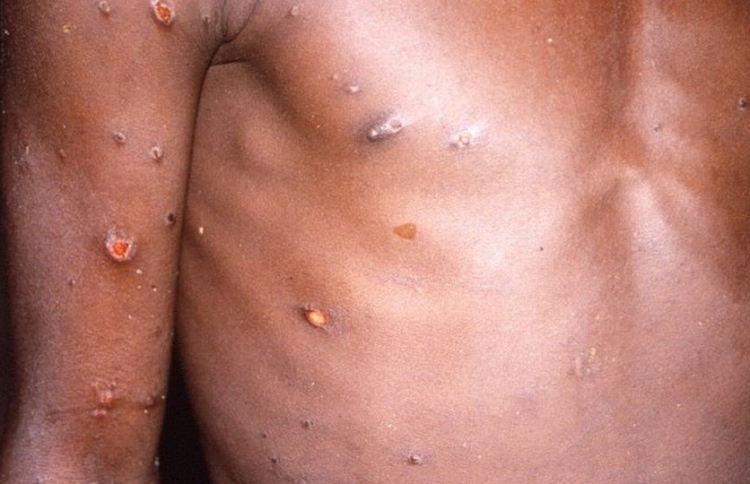 އެއްޖިންސުން ގުޅުން ހިންގާ މީހުންގެ ތެރޭ މަންކީޕޮކްސް