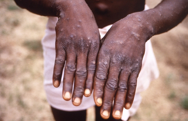 މަންކީ ޕޮކްސްއަށް ޝައްކުވާ މީހަކު ފެނިގެން ޓެސްޓްކުރަނީ