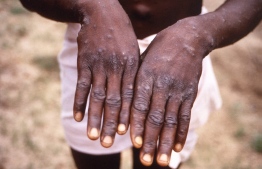 (FILES) In this file photo taken on January 07, 2011 this handout photo provided by the Centers for Disease Control and Prevention was taken in 1997 during an investigation into an outbreak of monkeypox, which took place in the Democratic Republic of the Congo (DRC), and depicts the dorsal surfaces of a monkeypox case in a patient who was displaying the appearance of the characteristic rash during its recuperative stage.. -- Photo by Brian W.J. Mahy / Centers for Disease Control and Prevention / AFP