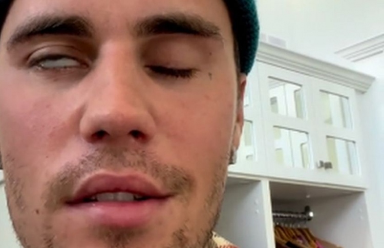 މަޝްހޫރު ލަވަކިޔުންތެރިޔާ ބީބާގެ މޫނުގެ އެއް ފަޅިން ވާގި ގޮސްފައި.