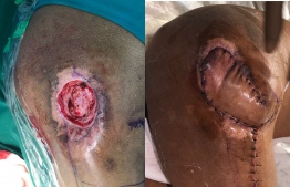 Before and after picture of Dr. Waheed's team performing surgery on a patients leg