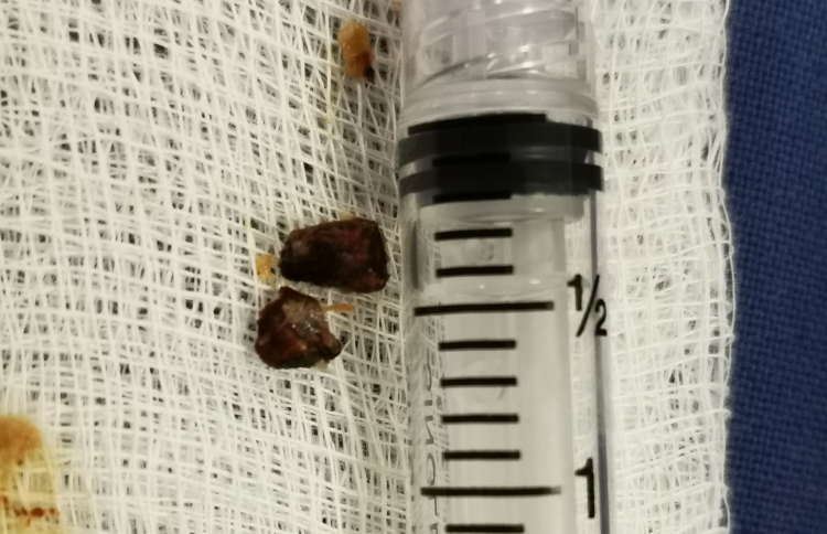 ފުއްޕާމޭގެ އިންފެކްޝަނެއް، ބެލިއިރު ސުޕާރީ ތާށިވެފައި!