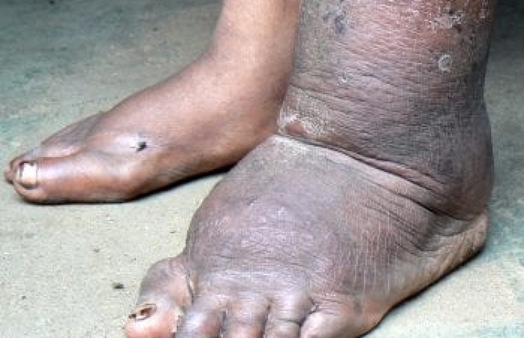 ފައިލޭރިޔާ ޖެހިފައިވާ ބަޔަކު ފެނިއްޖެ