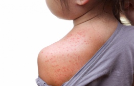 Rashes on the body caused by the disease chickenpox