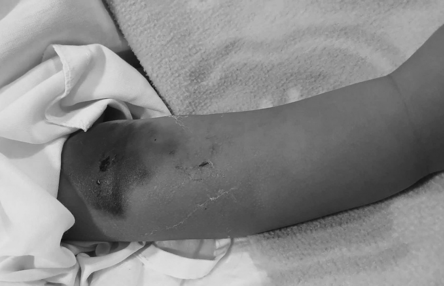 ކުޅުދުއްފުށި ރީޖަލަން ހޮސްޕިޓަލުގެ އައިސީޔޫގައި އޮތް 8 މަހުގެ ކުއްޖާގެ އަތް---