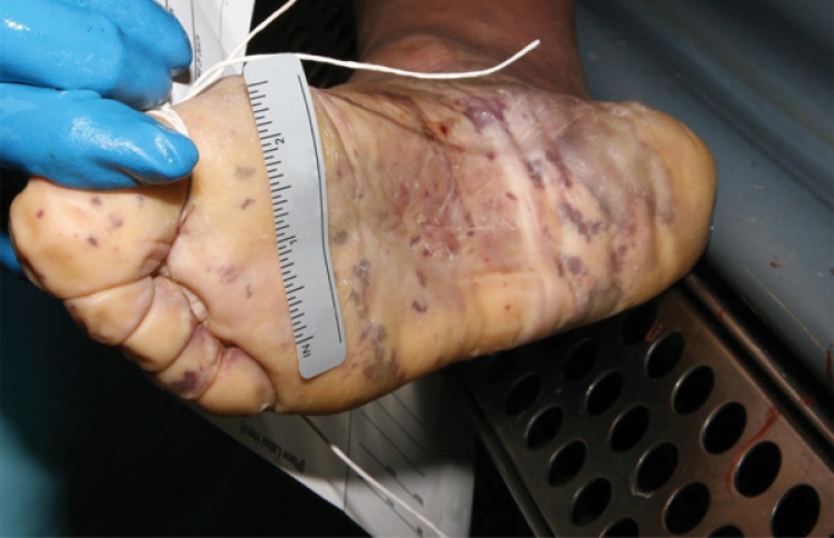 އިންވޭސިވް މެނިންގޯކޮކަލް ބައްޔަކީ ކޮބާ؟