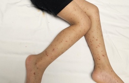 A patient of Invasive Meningococcal Disease (IMD) with rashes on the legs.