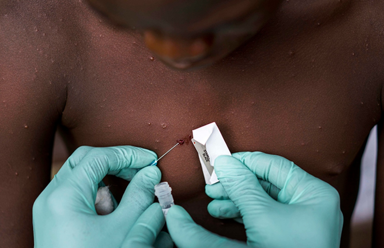 މަންކީ ޕޮކްސް ޖެހިފައިވާ މީހެއްގެ ގައިން ސާމްޕަލް ނަގަނީ.--