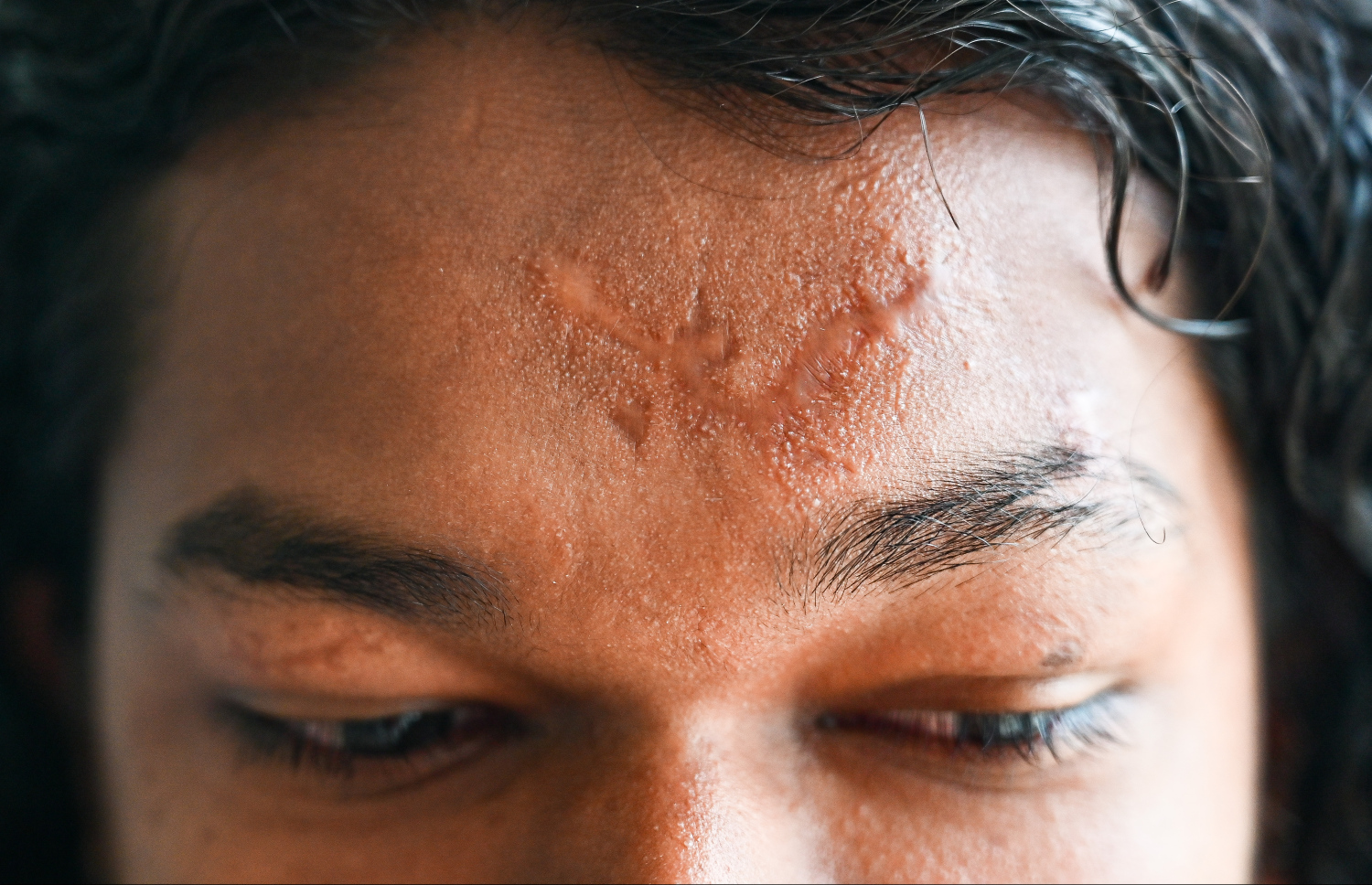 ކޮންކްރީޓުގަނޑު ވެއްޓި ބޮލަށް ލިބުނު އަނިޔާގެ ނިޝާނެއް ފިރުޝާންގެ ނިތްކުރިމަތީގައި.-- ފޮޓޯ: ފަޔާޒް މޫސާ | މިހާރު