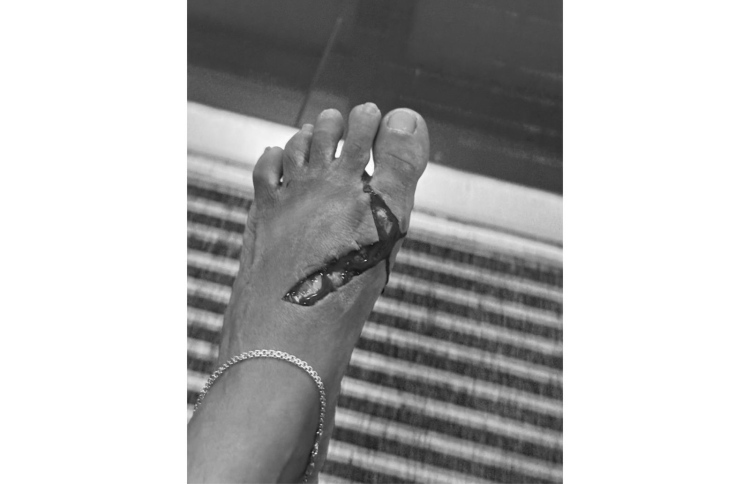 ސައިކަލުގެ ޕެޑަލްއަކުން ޖެހި ފަޔަށް ބޮޑު އަނިޔާއެއް